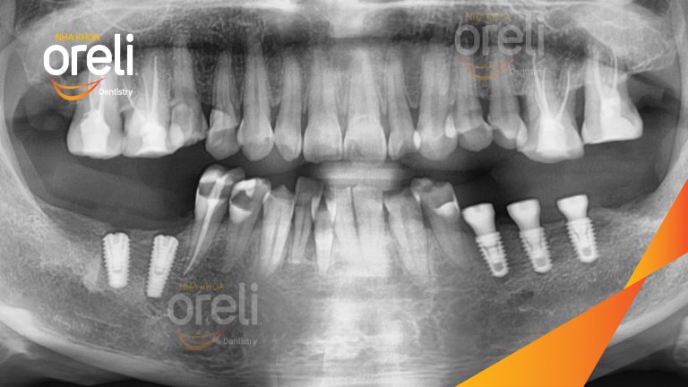 Ca Cấy Ghép Implant Phục Hồi Răng Tại Nha Khoa Oreli