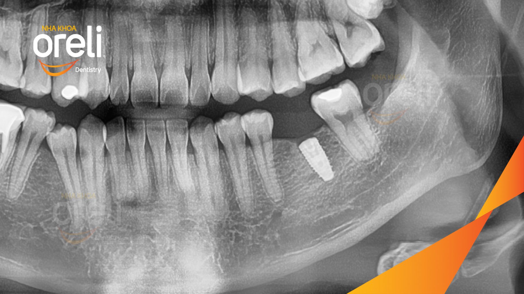 Mất răng hàm dưới trước khi điều trị tại Oreli