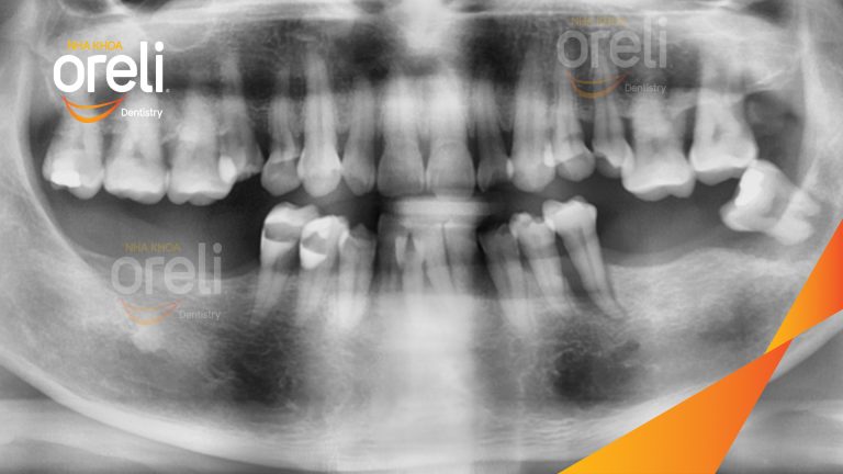 Ca Cấy Ghép Implant Phục Hồi Răng Tại Nha Khoa Oreli
