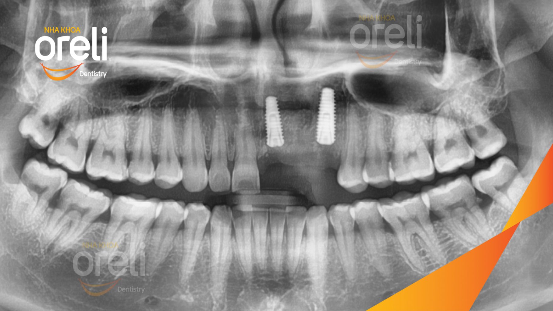 Mất răng hàm trên trước khi điều trị tại Oreli
