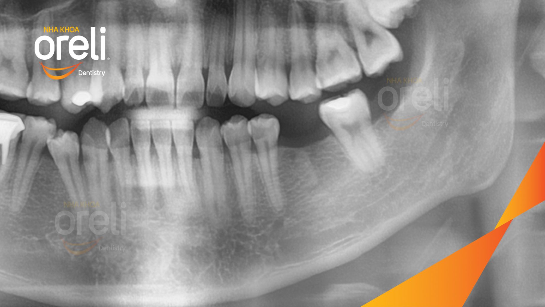 Trước điều trị: Mất răng hàm dưới tại Oreli