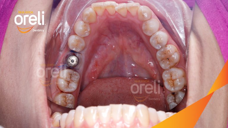 Ca Cấy Ghép Implant Phục Hồi Răng Tại Nha Khoa Oreli