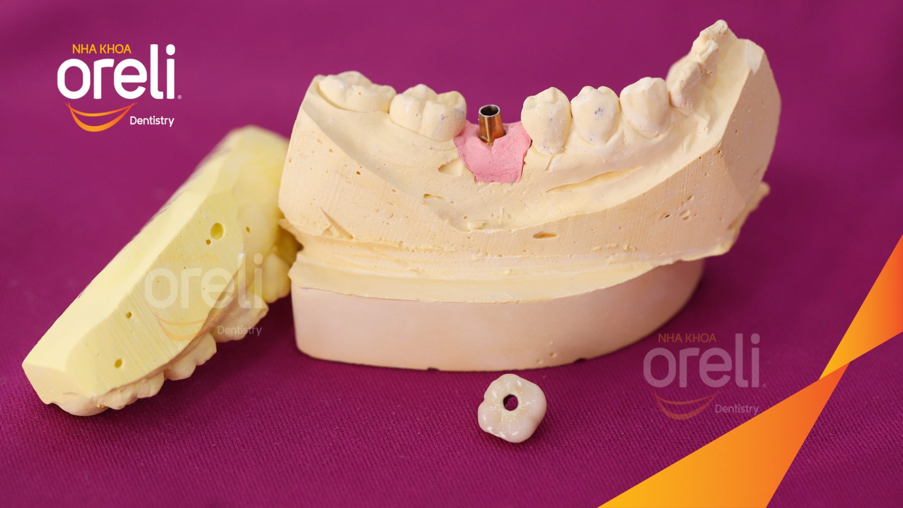 Kết quả sau 3 tháng: Hoàn thành đặt trụ Implant đúng vị trí mất răng tại Oreli