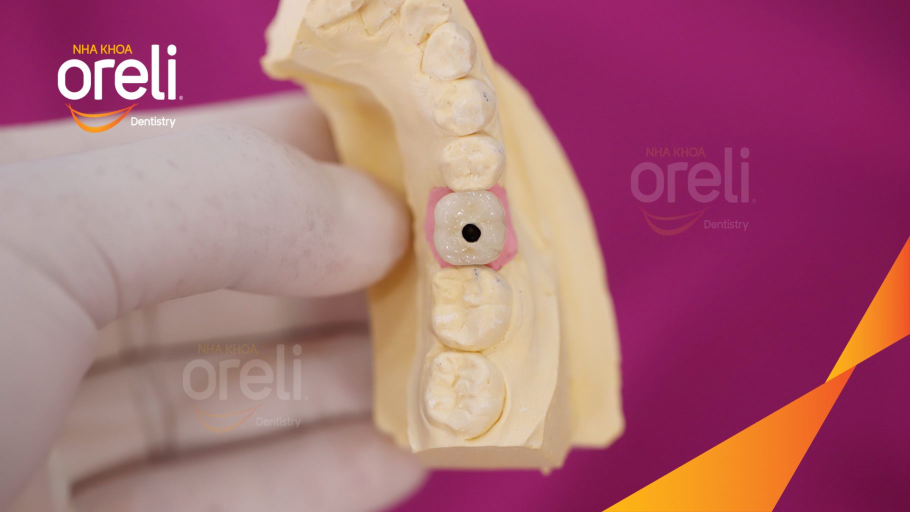 Kết quả đạt được sau 3 tháng - Hoàn thành đặt trụ Implant đúng vị trí mất răng tại Oreli