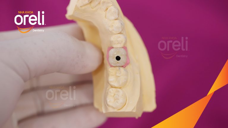 Ca Cấy Ghép Implant Phục Hồi Răng Tại Nha Khoa Oreli