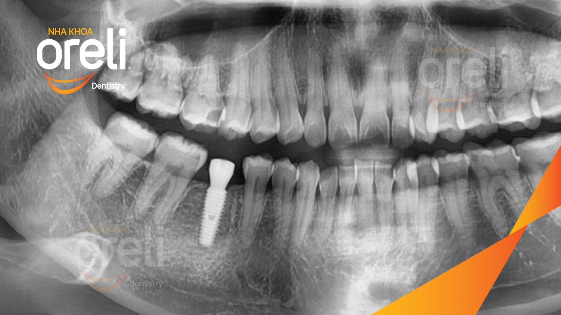 Mất răng hàm dưới trước khi điều trị tại Oreli