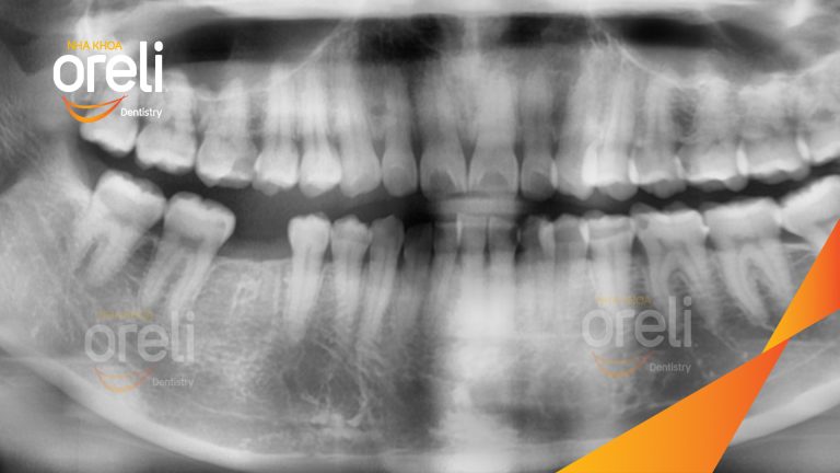 Ca Cấy Ghép Implant Phục Hồi Răng Tại Nha Khoa Oreli