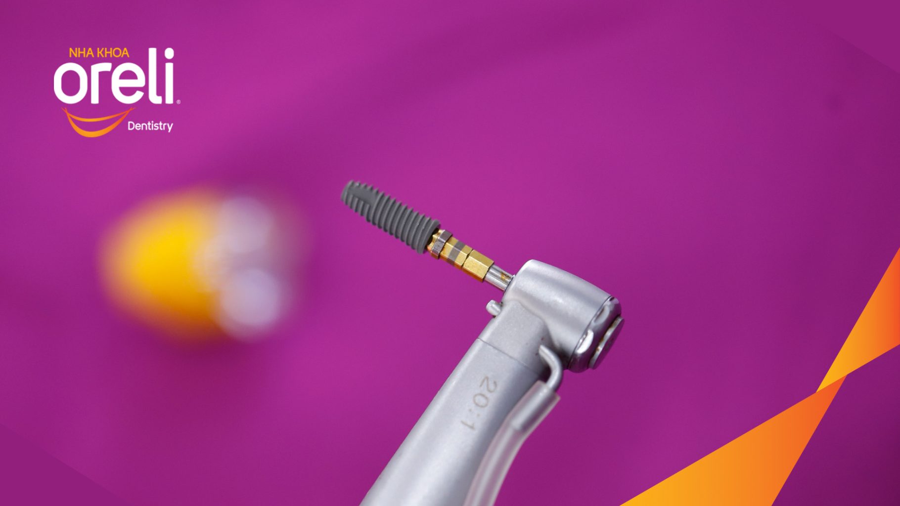 Thực hiện Cấy ghép trụ Implant chính hãng vào vùng mất răng kéo dài 3 tháng tại Oreli