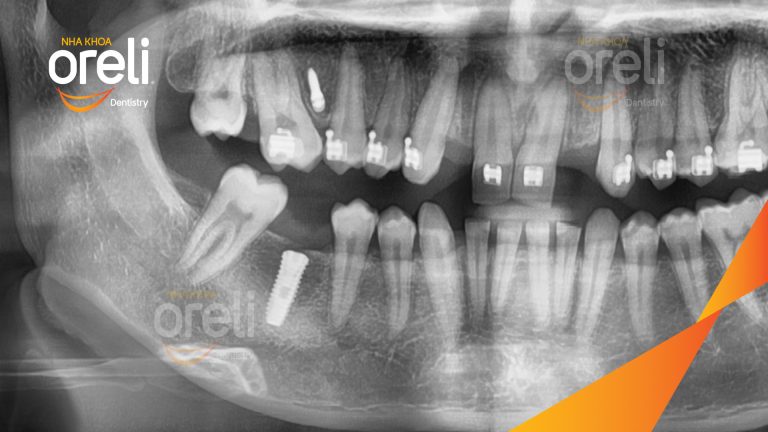 Ca Cấy Implant Hàm Dưới Tại Nha Khoa Oreli