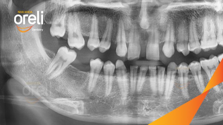Ca Cấy Implant Hàm Dưới Tại Nha Khoa Oreli