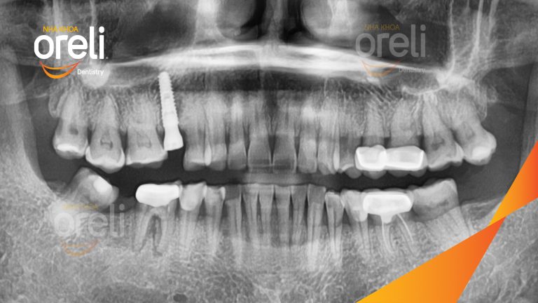 Ca Cấy Ghép Implant Hàm Trên– Case thực tế tại Oreli