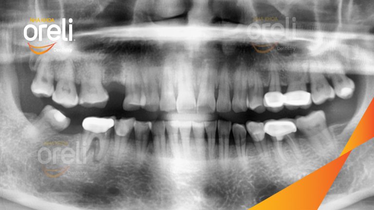 Ca Cấy Ghép Implant Hàm Trên– Case thực tế tại Oreli