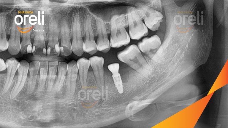 Ca Cấy Ghép Implant Phục Hồi Răng Tại Nha Khoa Oreli