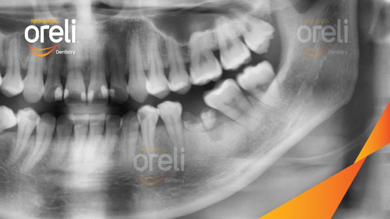 Ca Cấy Ghép Implant Phục Hồi Răng Tại Nha Khoa Oreli