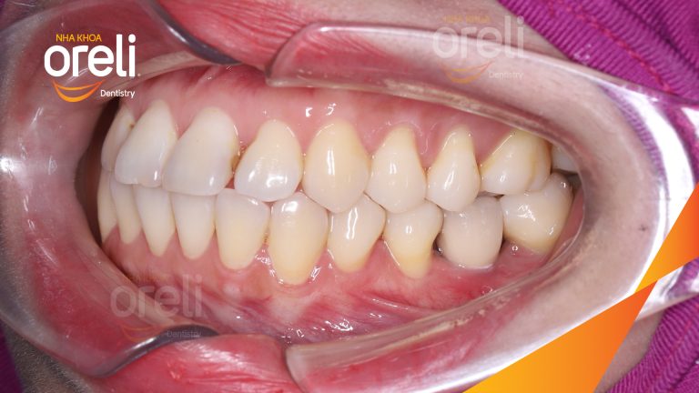 Ca Cấy Ghép Implant Phục Hồi Răng Tại Nha Khoa Oreli