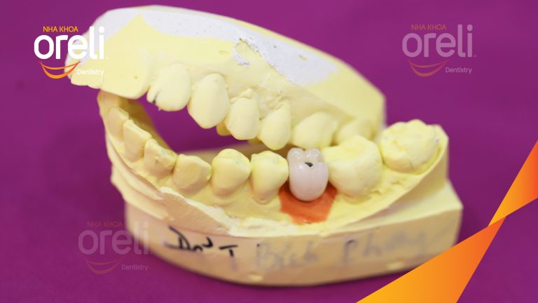 Ca Cấy Ghép Implant Phục Hồi Răng Tại Nha Khoa Oreli
