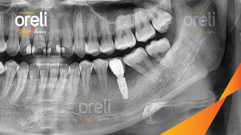 Ca Cấy Ghép Implant Phục Hồi Răng Tại Nha Khoa Oreli
