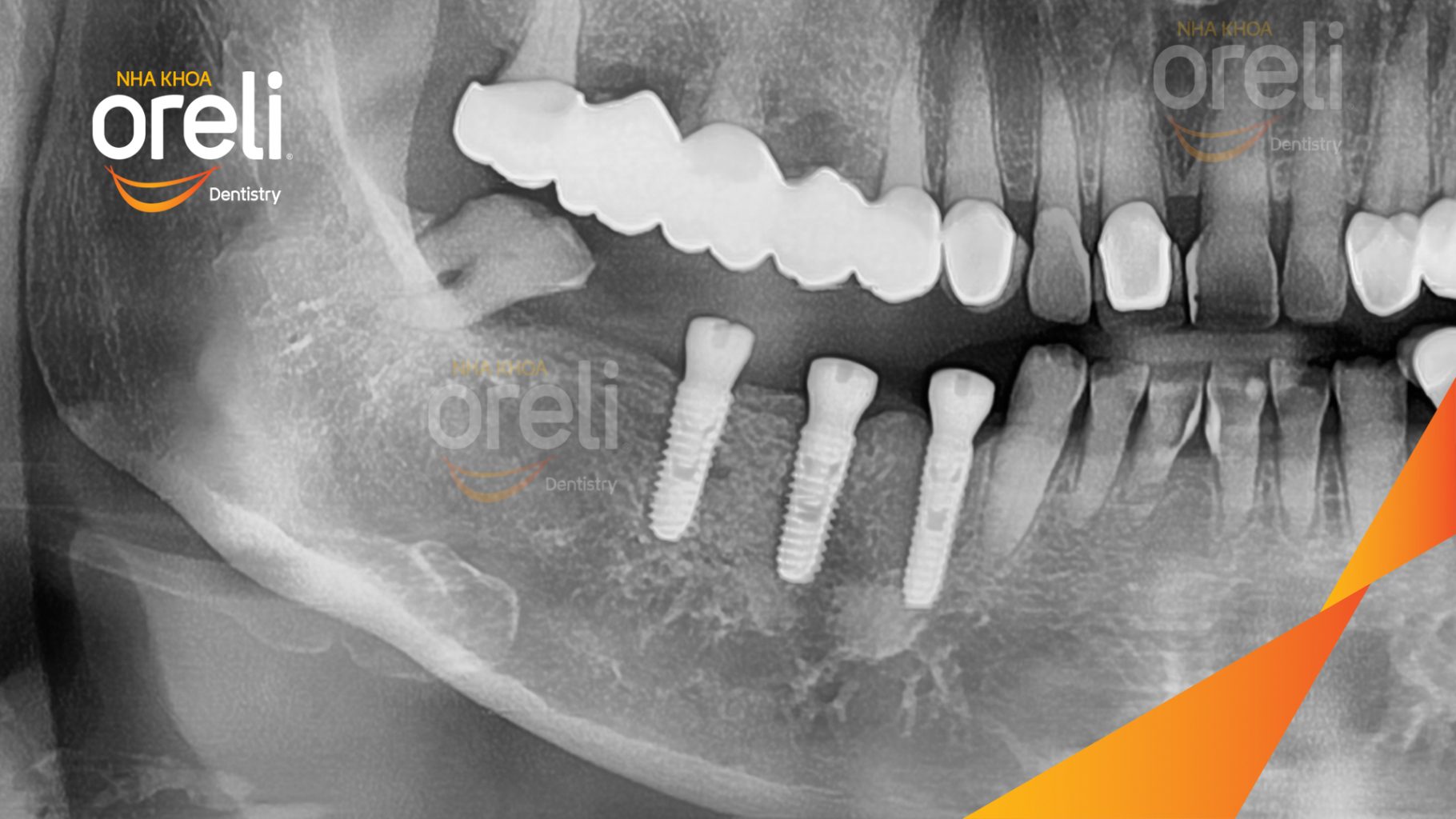 Mất răng hàm dưới trước khi điều trị tại Oreli