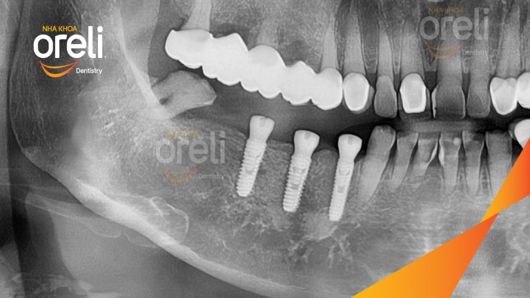 Ca Cấy Ghép Implant Phục Hồi Răng Tại Nha Khoa Oreli