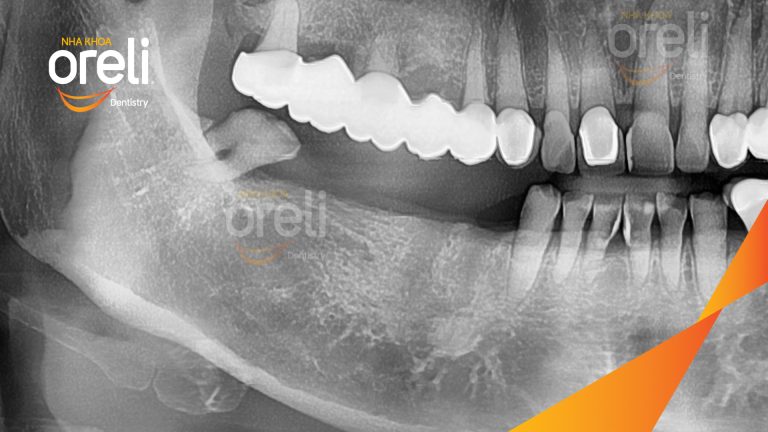 Ca Cấy Ghép Implant Phục Hồi Răng Tại Nha Khoa Oreli