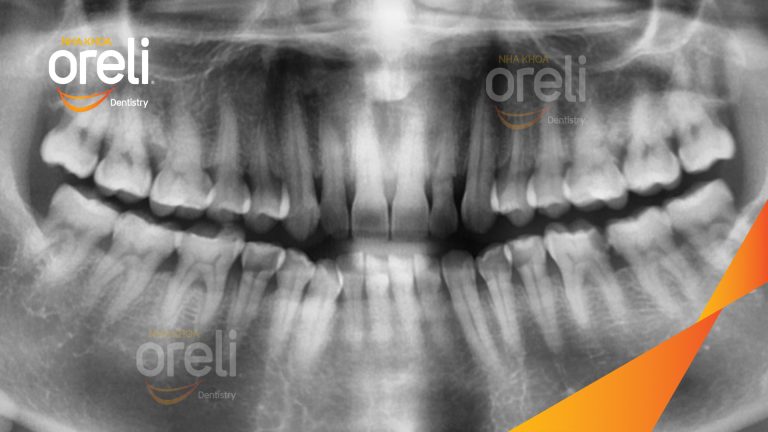 Ca Cấy Ghép Implant Hàm Trên – Case thực tế tại Oreli