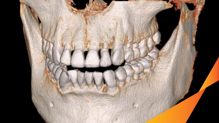 Ca Cấy Ghép Implant Hàm Trên – Case thực tế tại Oreli