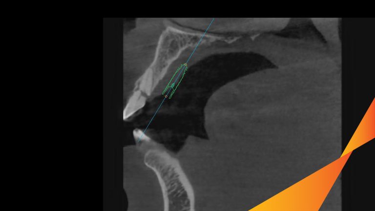 Ca Cấy Ghép Implant Hàm Trên – Case thực tế tại Oreli