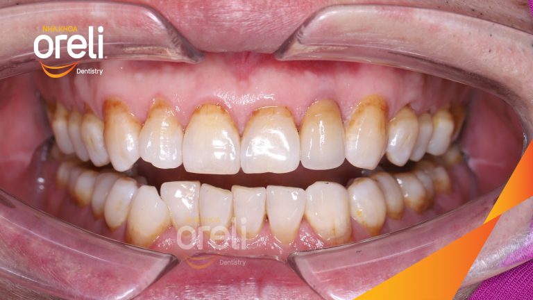 Ca Cấy Ghép Implant Hàm Trên – Case thực tế tại Oreli