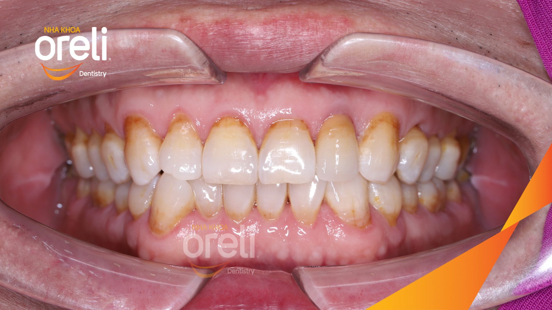 Thực hiện Cấy ghép trụ Implant chính hãng vào vùng mất răng kéo dài 3 tháng tại Oreli