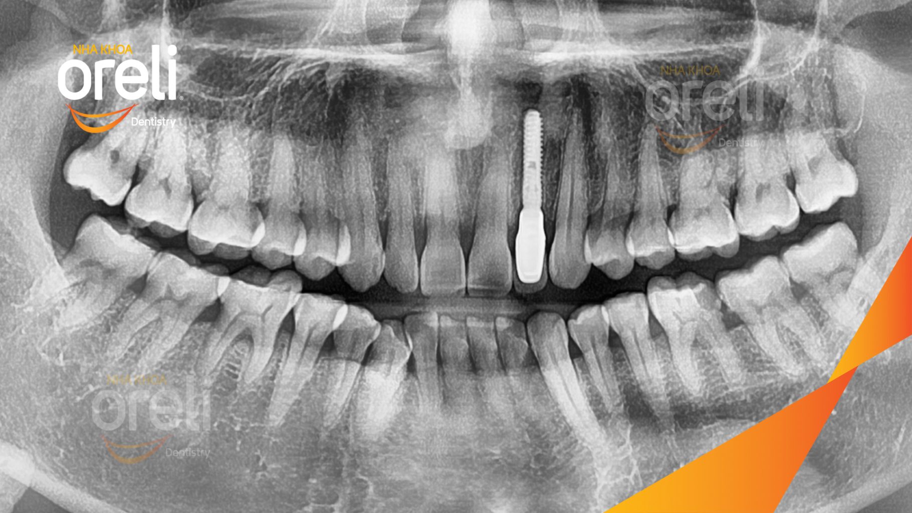 Mất răng hàm trên trước khi điều trị tại Oreli
