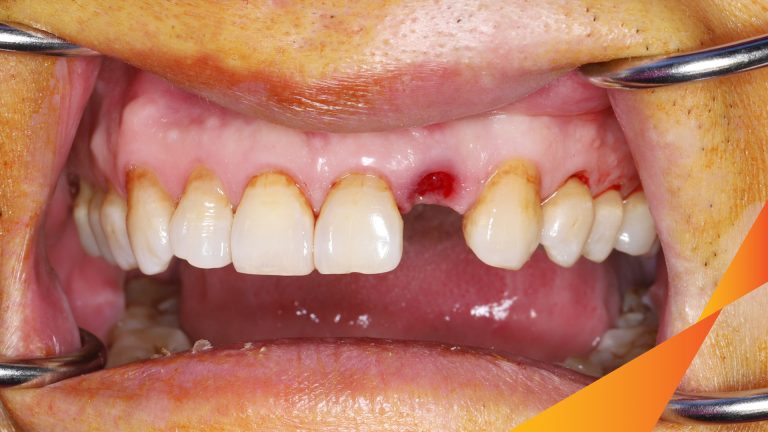 Ca Cấy Ghép Implant Hàm Trên – Case thực tế tại Oreli