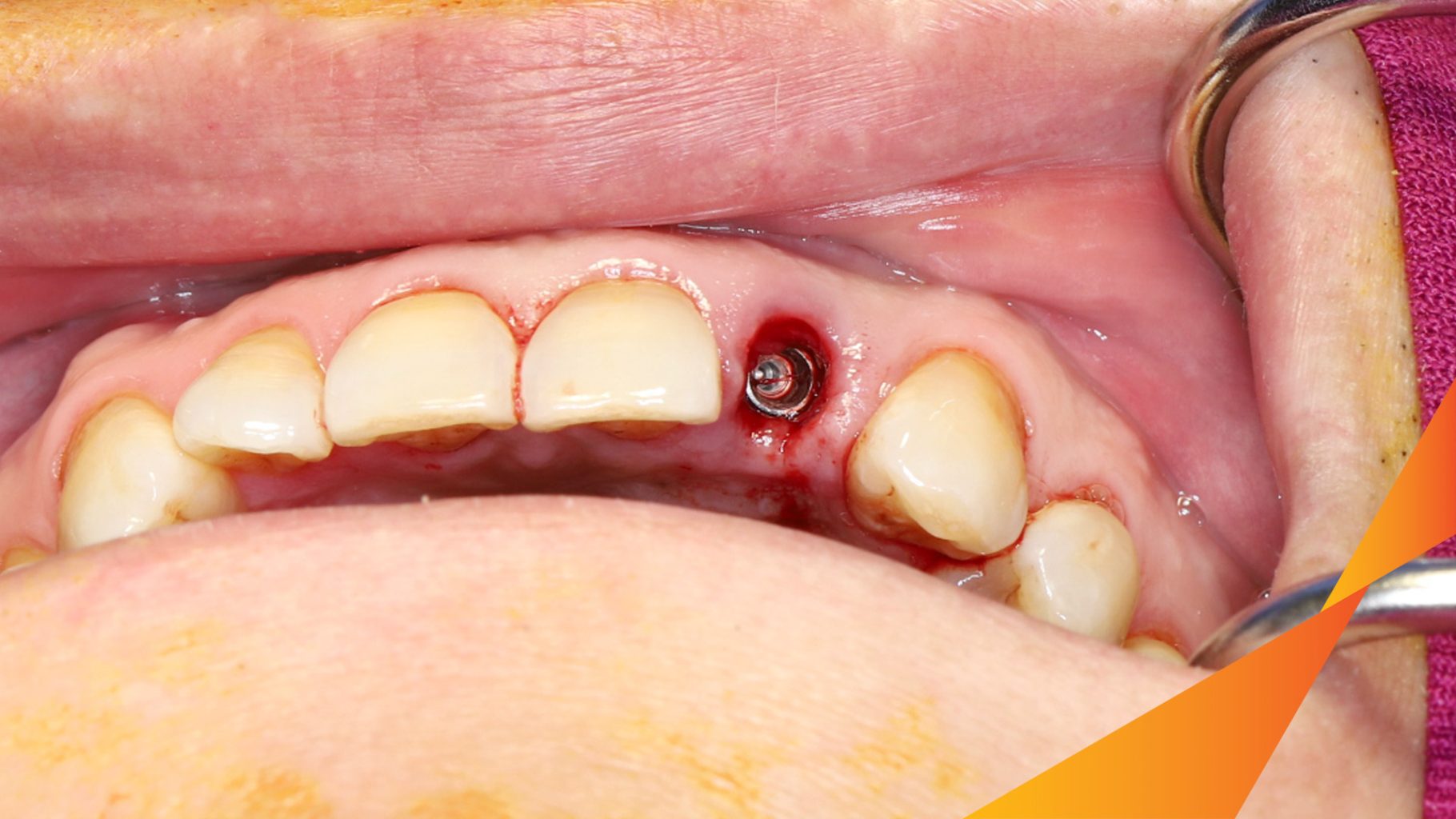 Kết quả đạt được sau 3 tháng - Hoàn thành đặt trụ Implant đúng vị trí mất răng tại Oreli
