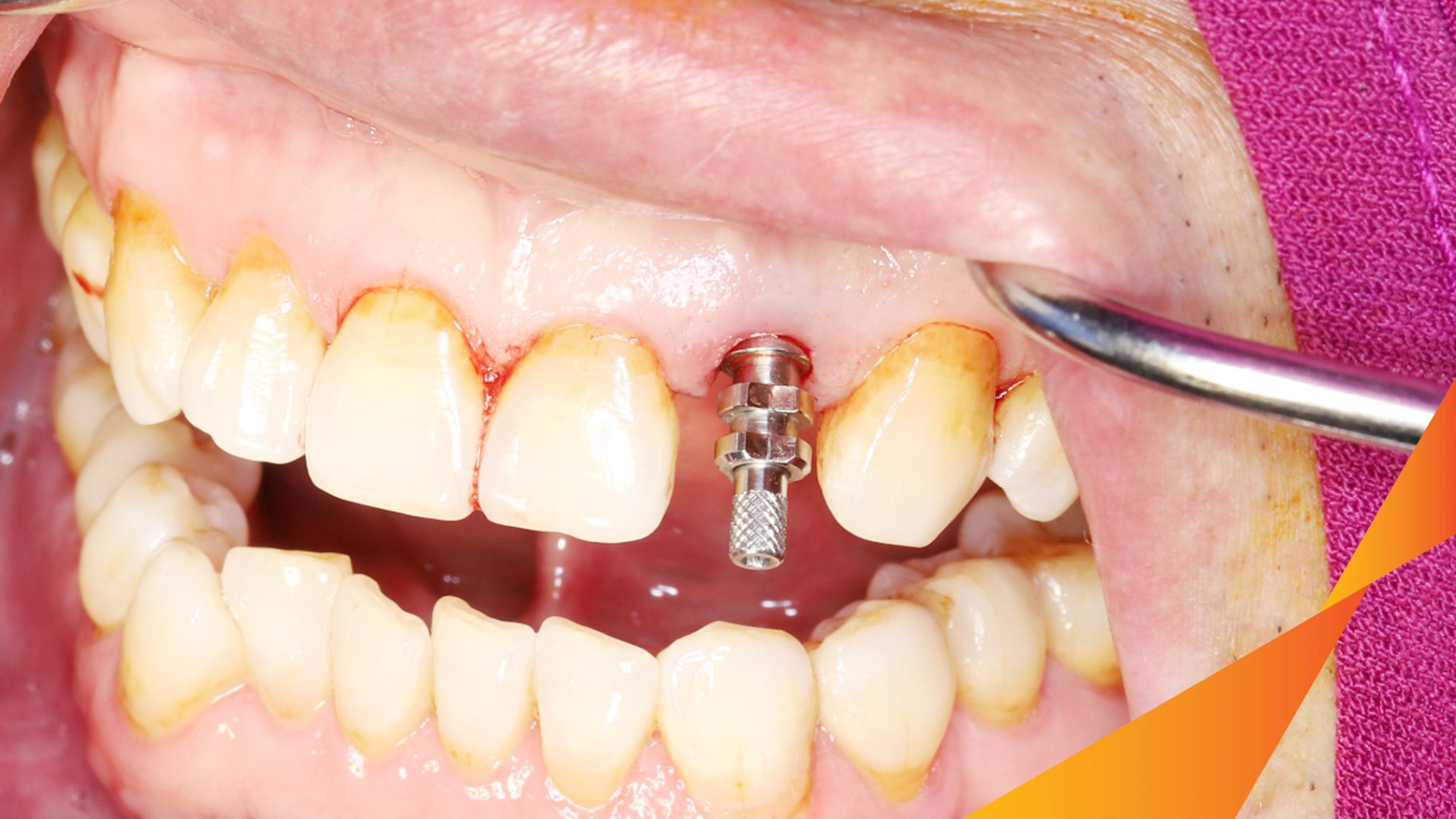 Trước điều trị: Mất răng hàm trên tại Oreli