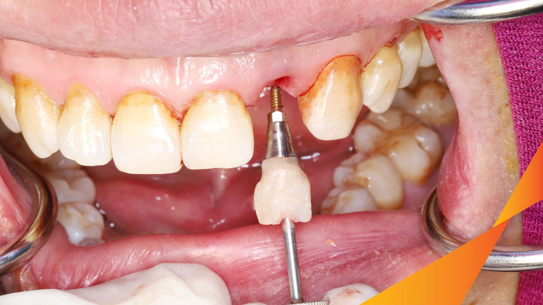 Mất răng hàm trên trước khi điều trị tại Oreli