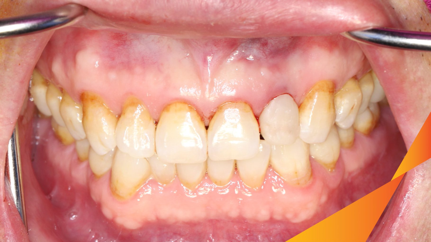Quá trình Cấy ghép trụ Implant chính hãng vào vùng mất răng trong 3 tháng tại Oreli