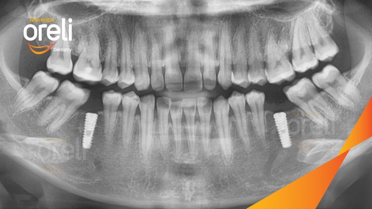 Ca Cấy Ghép Implant Phục Hồi Răng Tại Nha Khoa Oreli