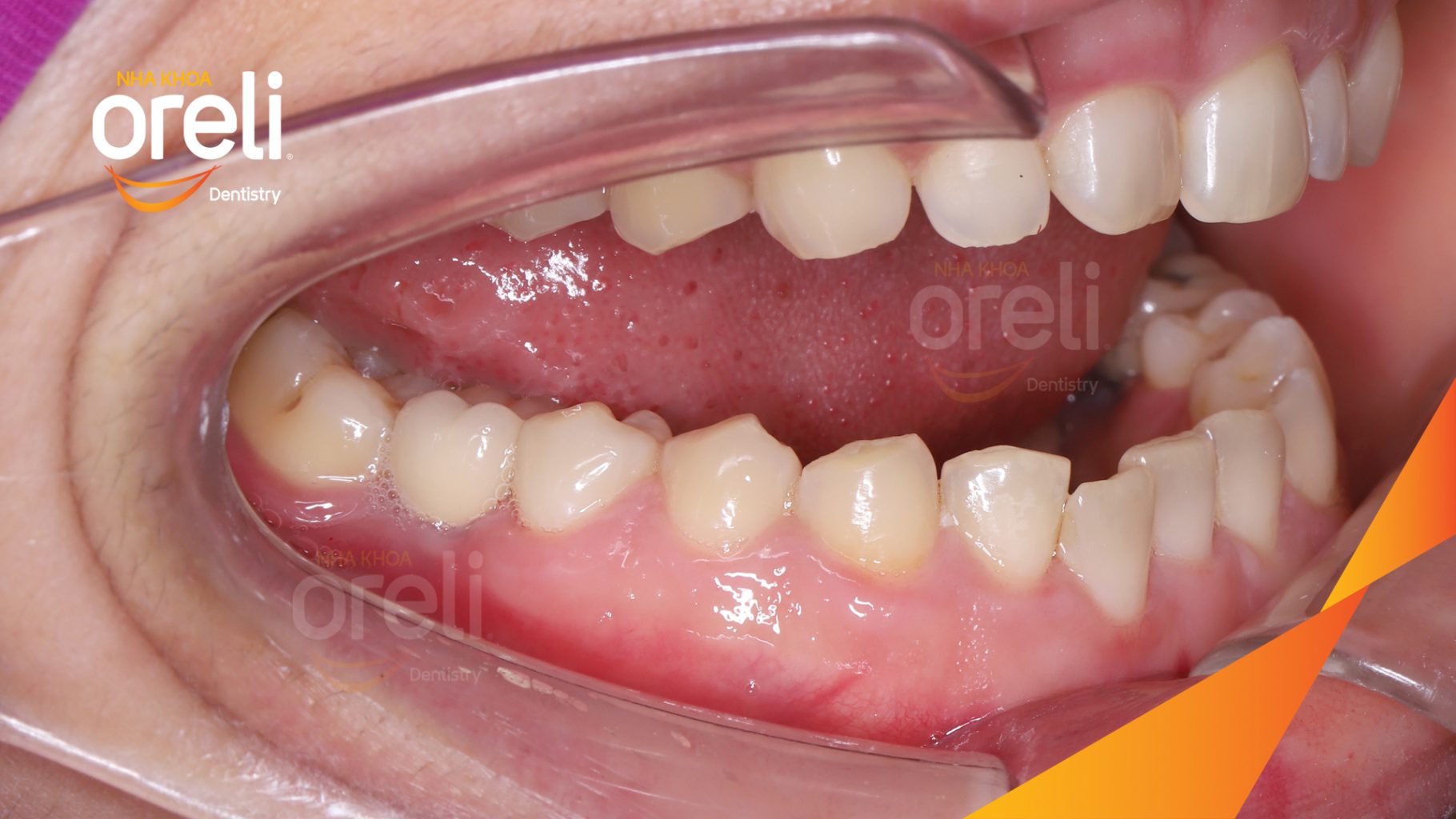 Quá trình Cấy ghép trụ Implant chính hãng vào vùng mất răng trong 3 tháng tại Oreli