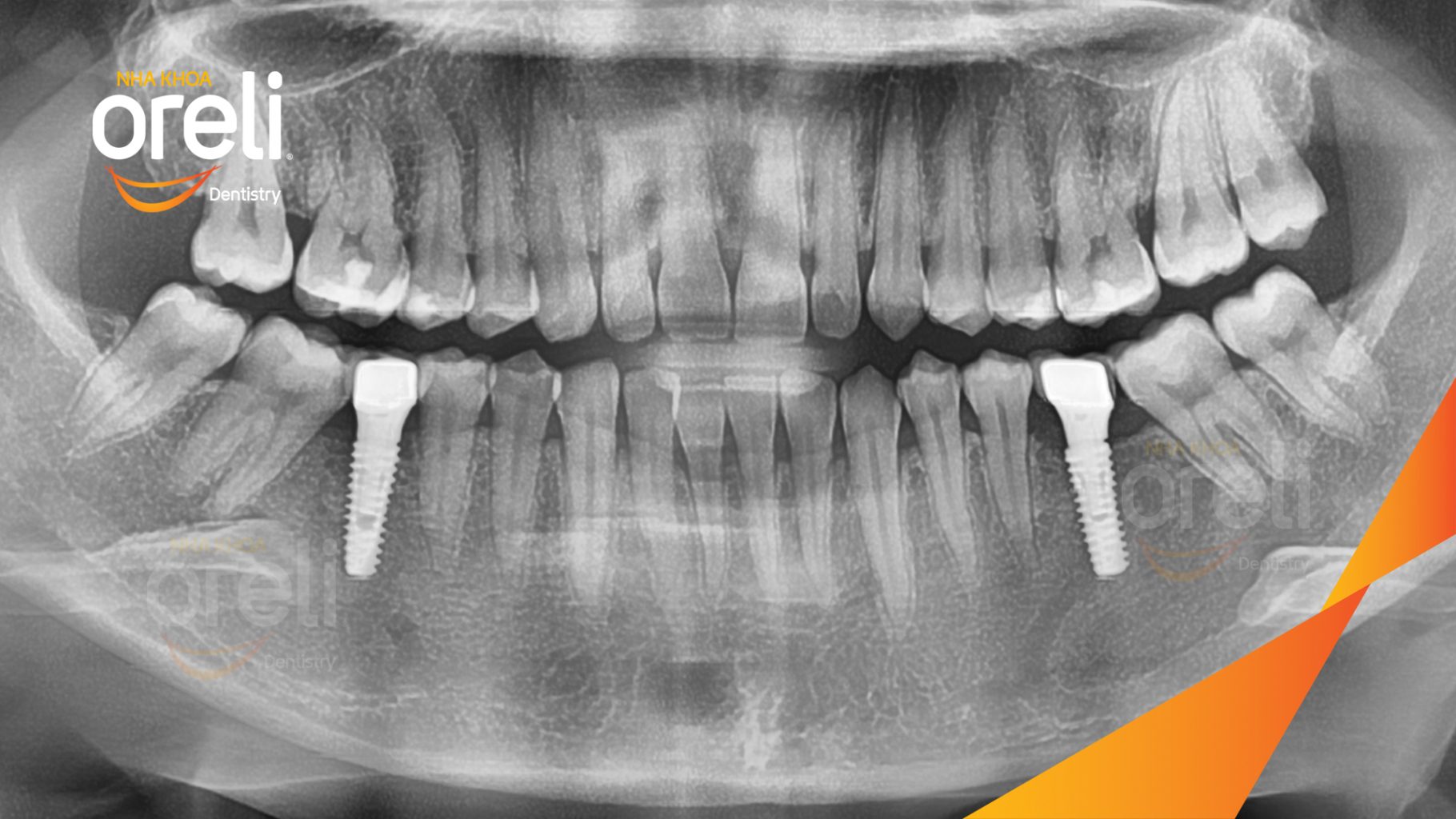 Quá trình Cấy ghép trụ Implant chính hãng vào vùng mất răng trong 3 tháng tại Oreli