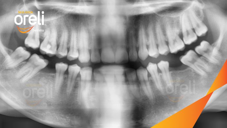 Ca Cấy Ghép Implant Phục Hồi Răng Tại Nha Khoa Oreli