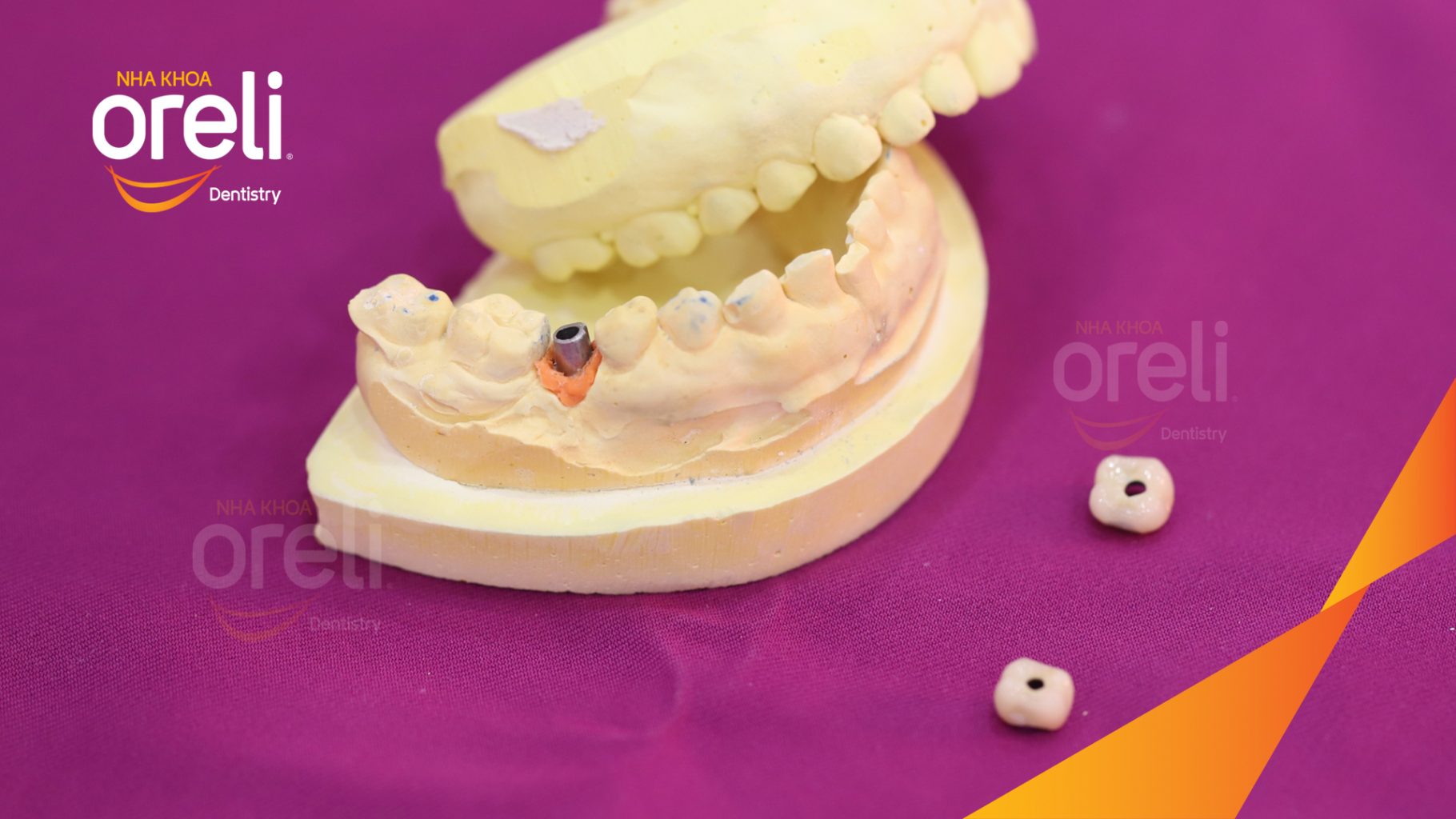 Kết quả đạt được sau 3 tháng - Phục hồi răng mất - ăn nhai chắc chắn và cười nói tự tin tại Oreli