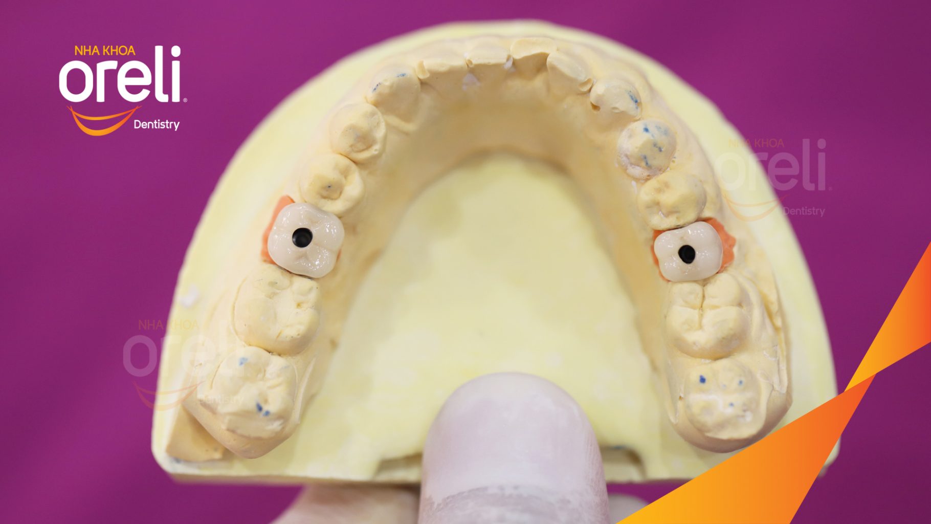Kết quả sau 3 tháng: Phục hồi răng mất - ăn nhai chắc chắn và cười nói tự tin tại Oreli