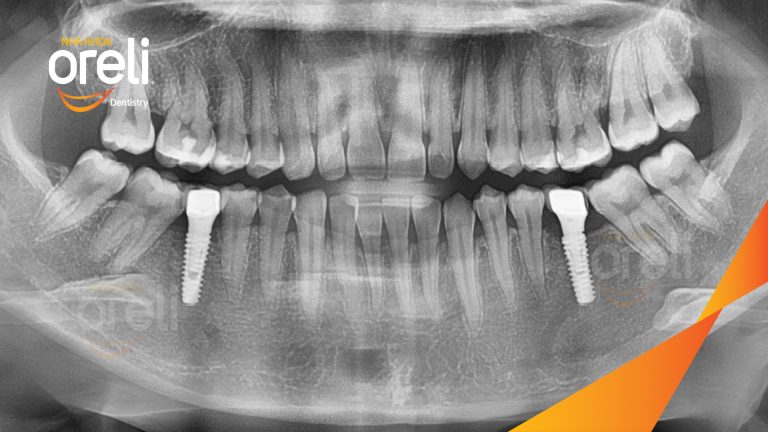Ca Cấy Ghép Implant Phục Hồi Răng Tại Nha Khoa Oreli