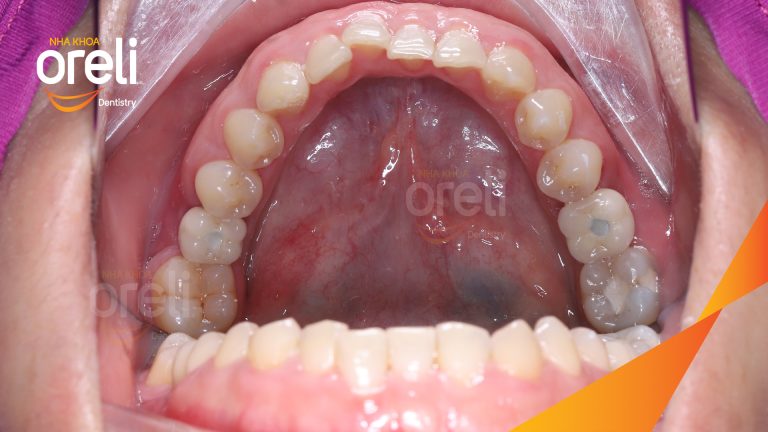 Ca Cấy Ghép Implant Phục Hồi Răng Tại Nha Khoa Oreli