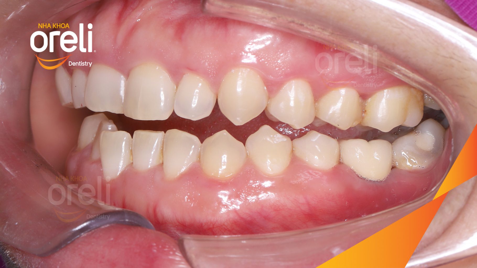 Mất răng hàm dưới trước khi điều trị tại Oreli