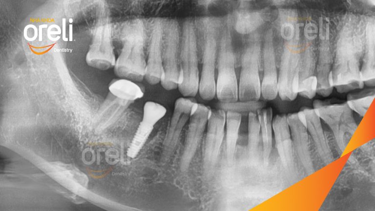 Ca Cấy Ghép Implant Phục Hồi Răng Tại Nha Khoa Oreli