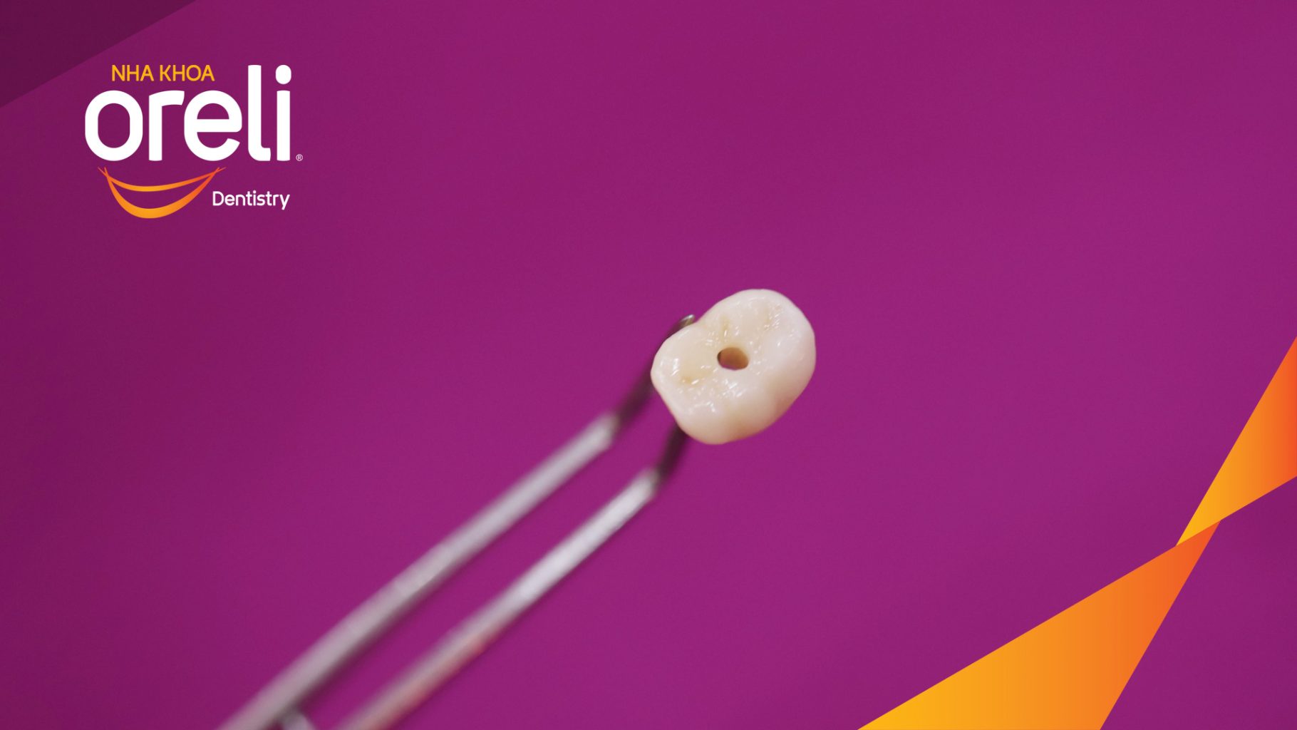 Thực hiện Cấy ghép trụ Implant chính hãng vào vùng mất răng kéo dài 3 tháng tại Oreli