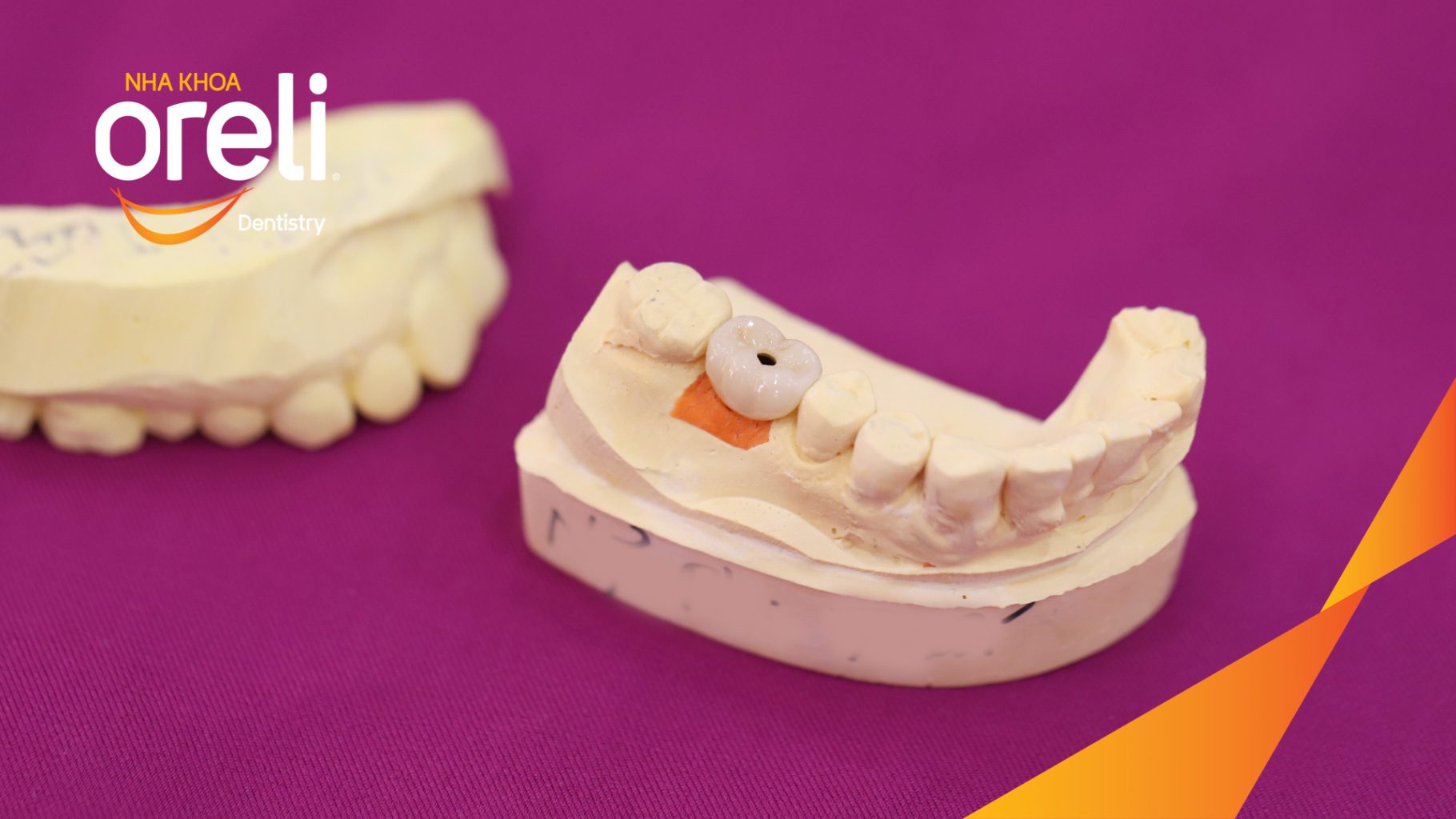 Quá trình Cấy ghép trụ Implant chính hãng vào vùng mất răng trong 3 tháng tại Oreli