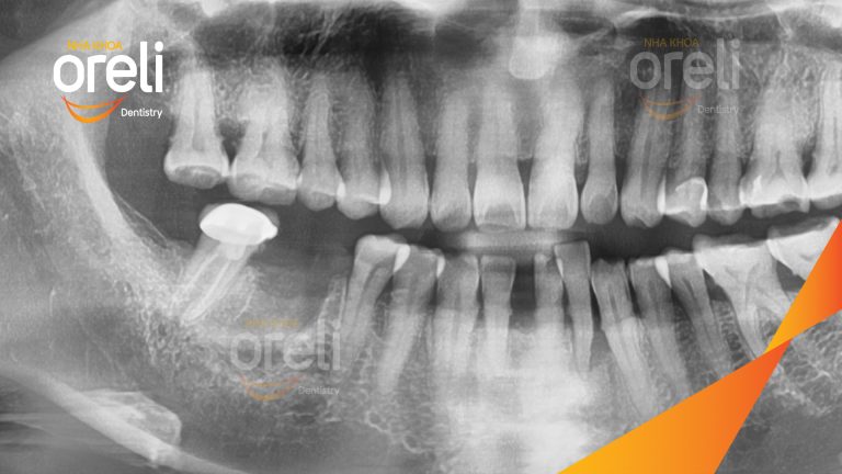Ca Cấy Ghép Implant Phục Hồi Răng Tại Nha Khoa Oreli