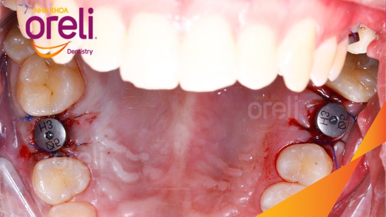 Ca Cấy Ghép Implant Phục Hồi Răng Tại Nha Khoa Oreli