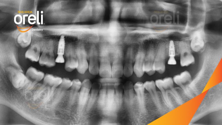 Ca Cấy Ghép Implant Phục Hồi Răng Tại Nha Khoa Oreli